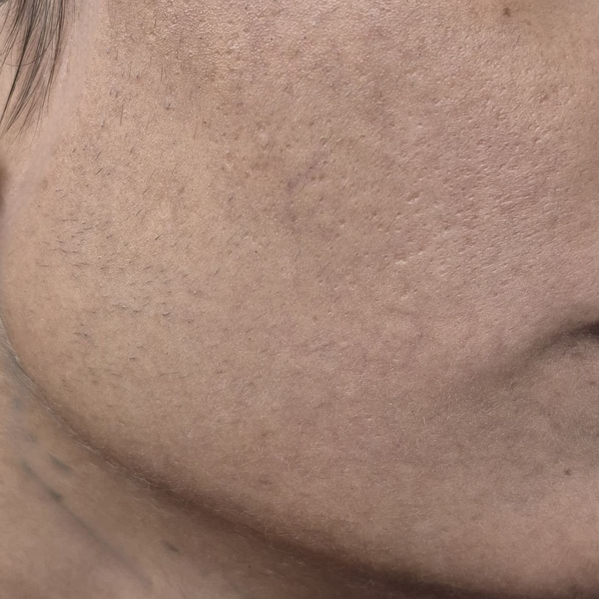 Laser Before