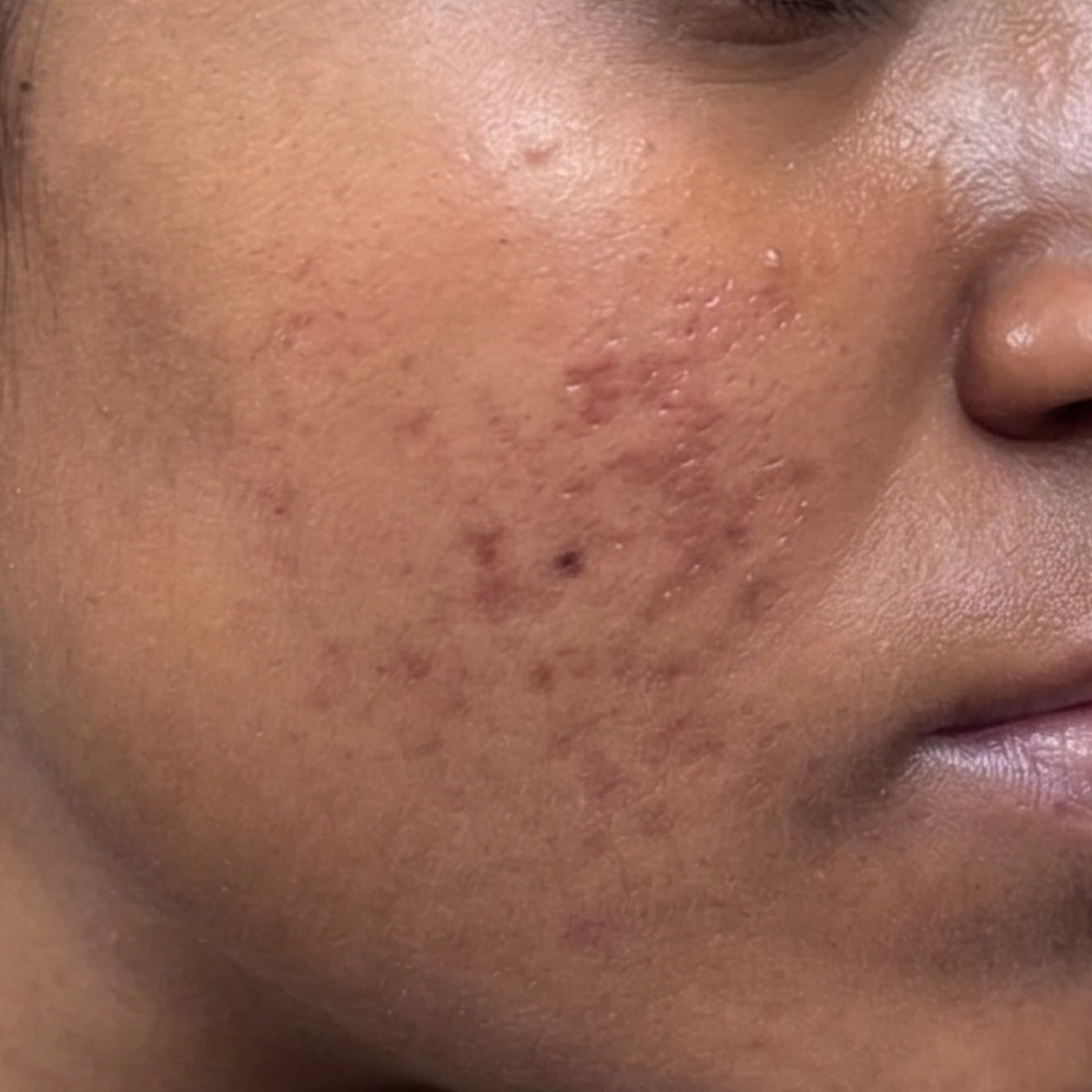 Acne After
