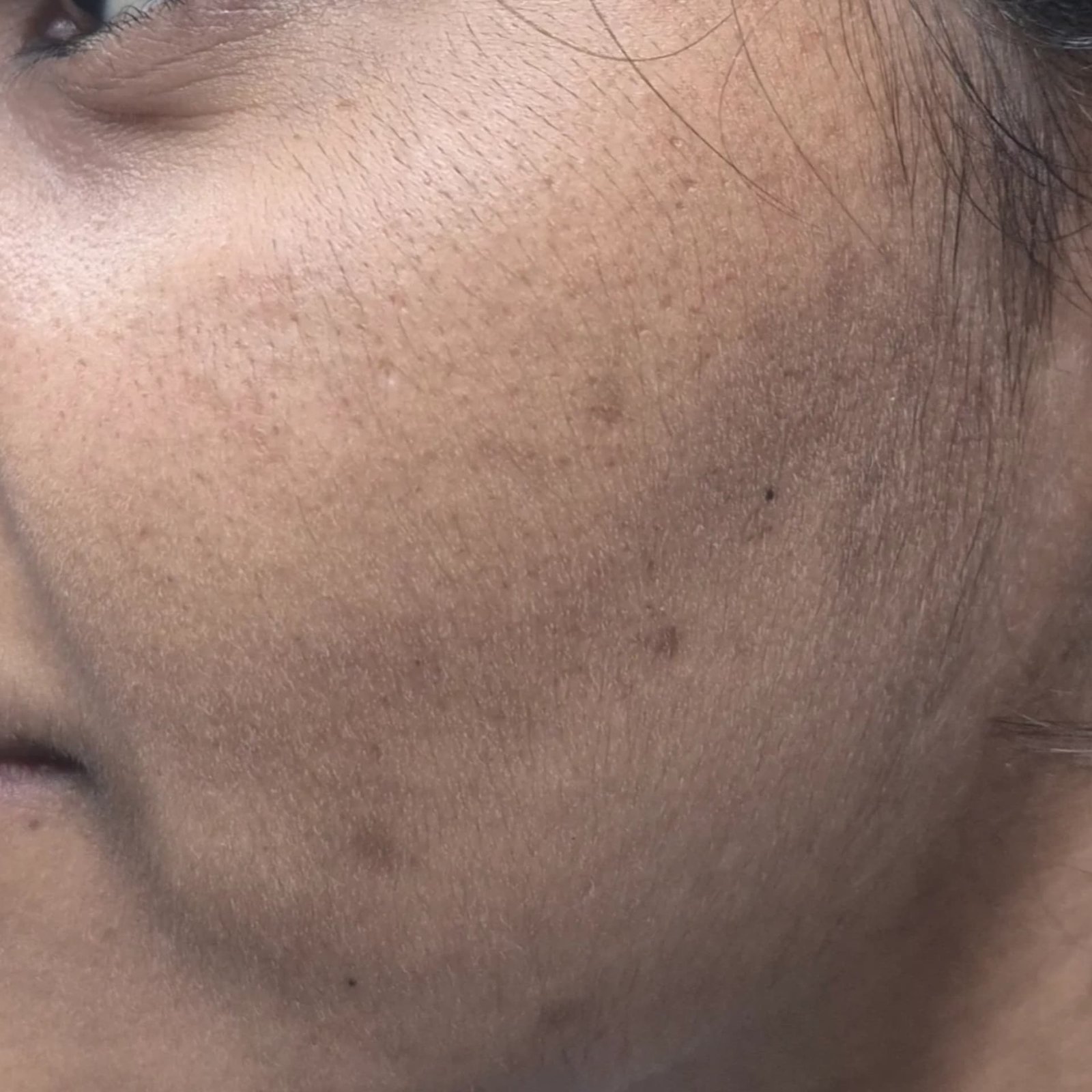 Pigmentation Patient 5 After