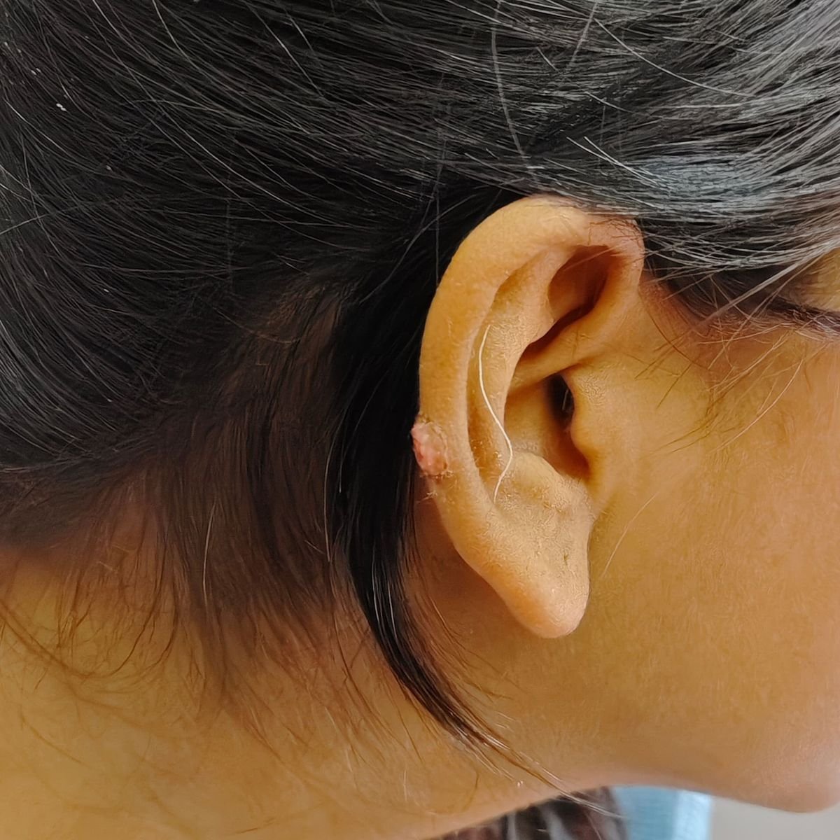 Keloid After