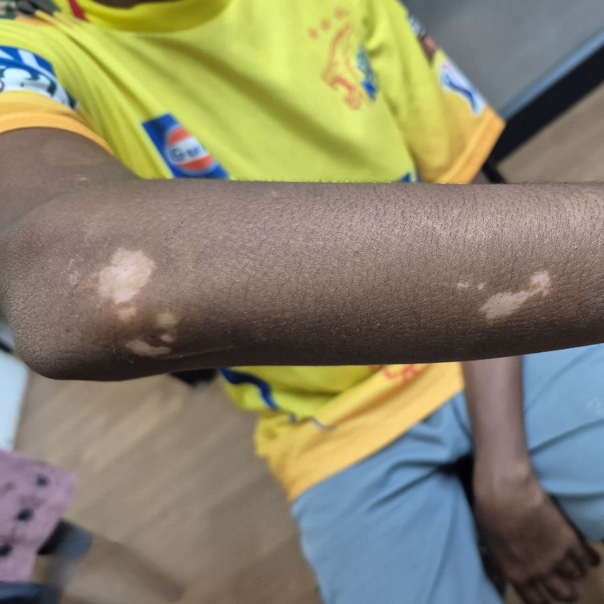 Vitiligo Patient 2 Before
