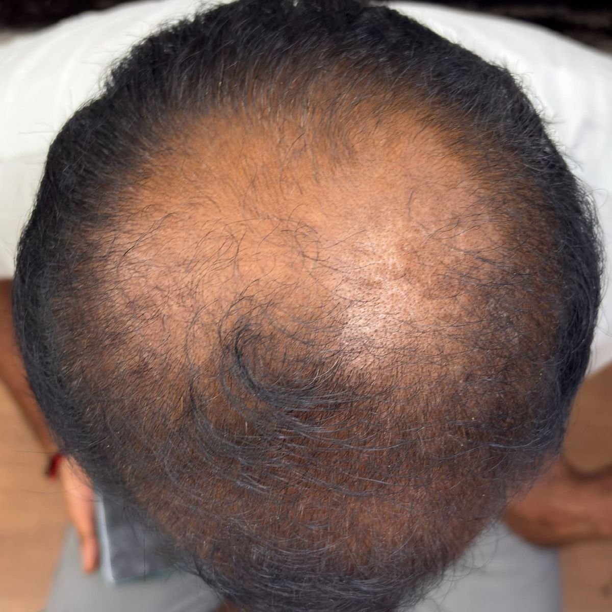 Hair Restoration Patient 4 Before