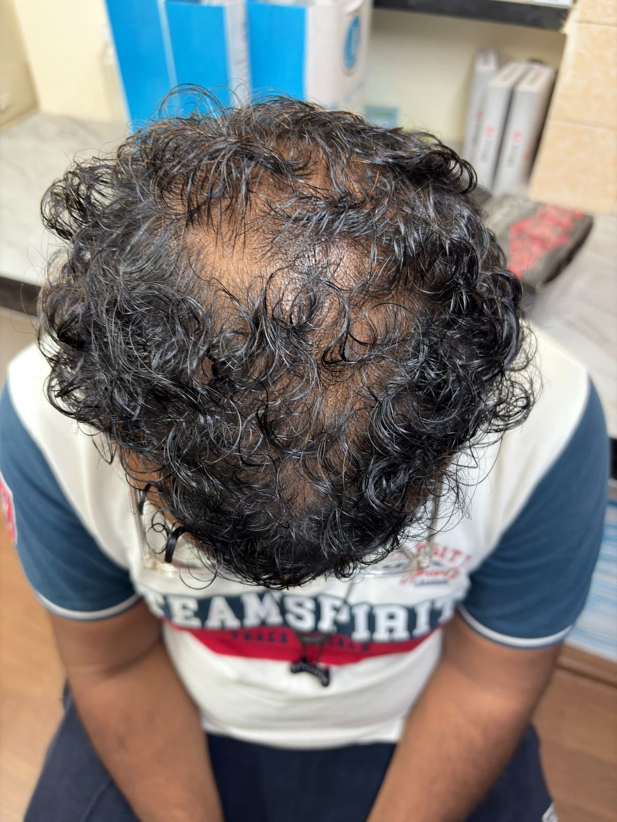 Hair Restoration Patient 3 Before