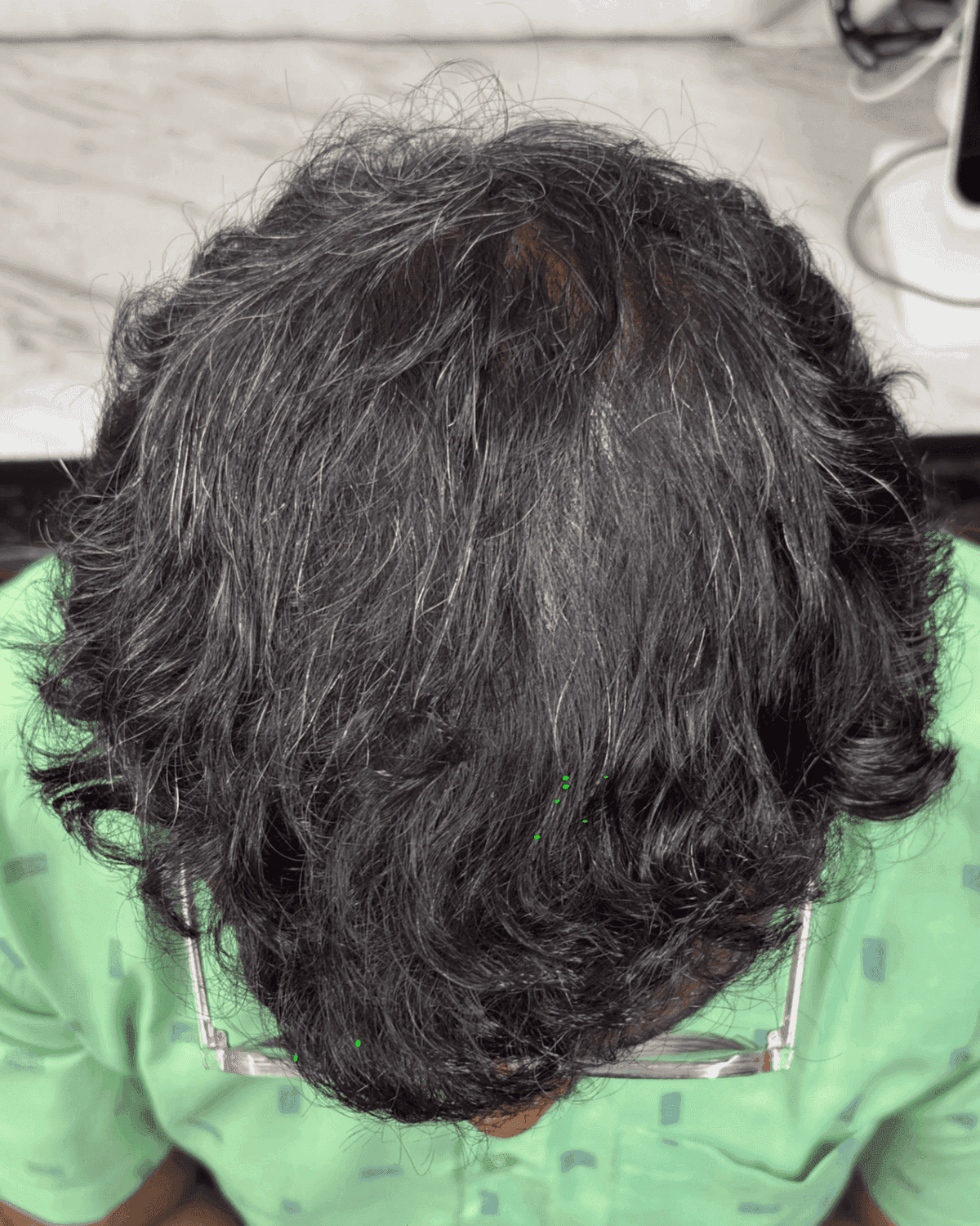Hair Restoration Patient 3 After
